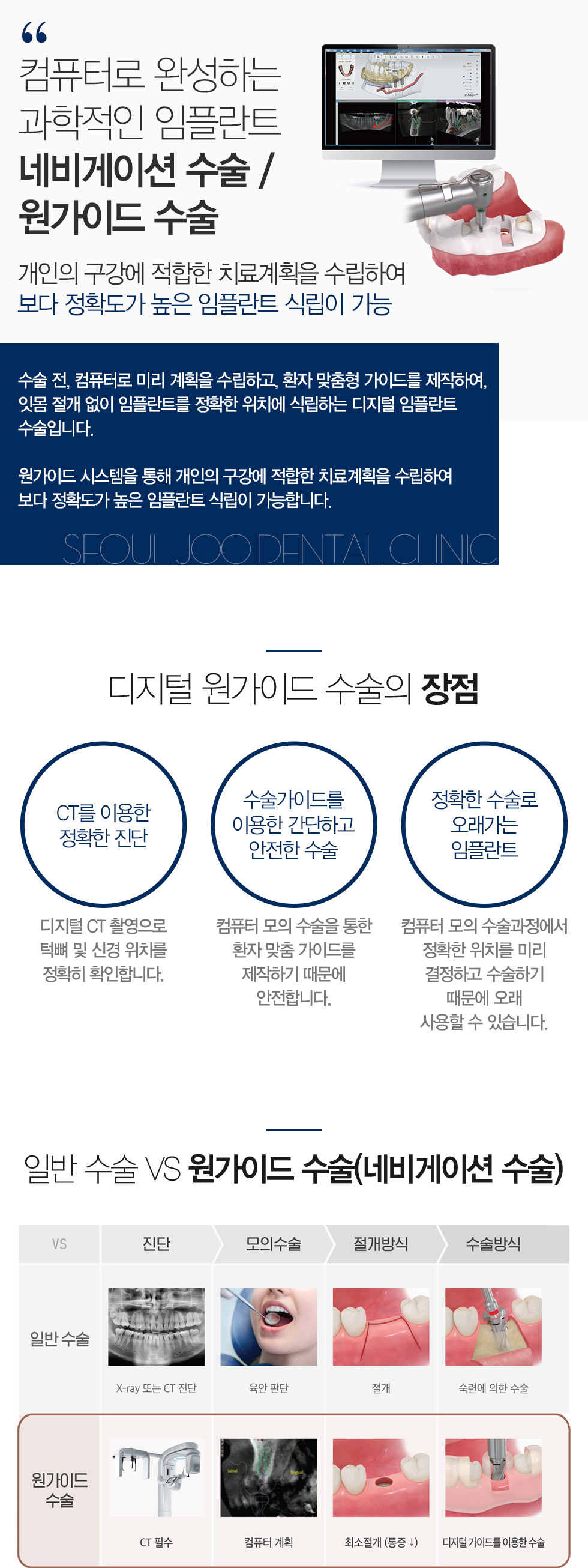 네비게이션 / 원가이드 수술